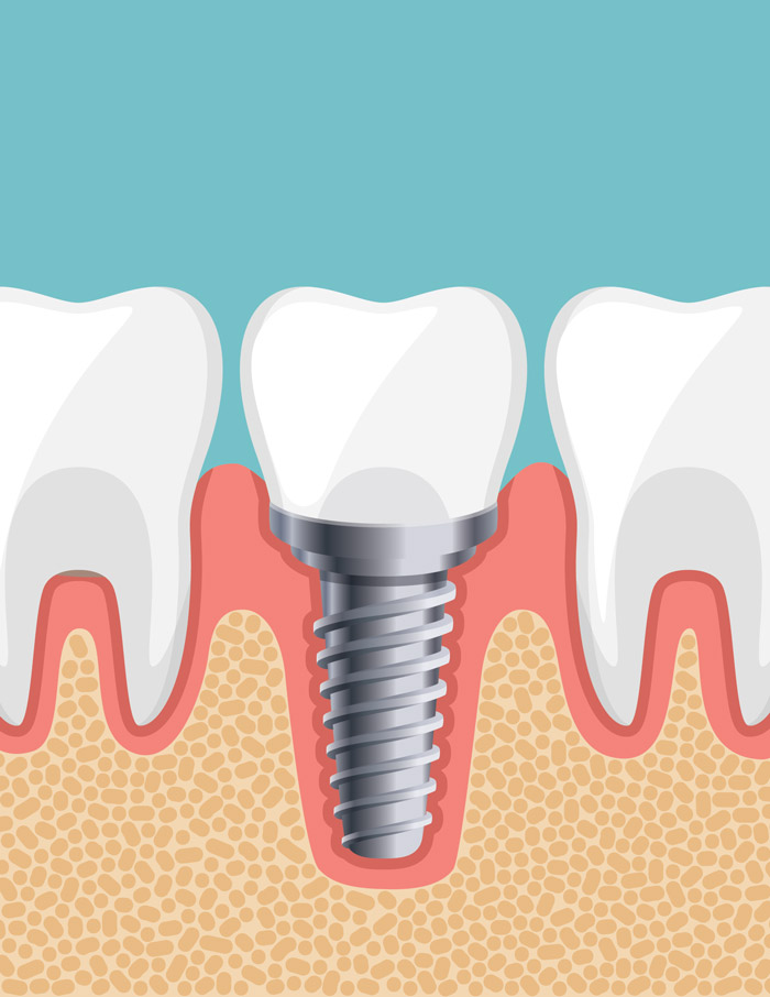 procedimento impianto dentale